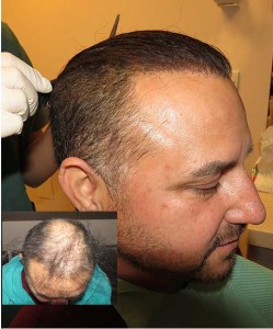 Exoderm Bio Artificial hair implant
