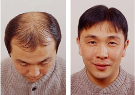 Artificial hair implant Biofibre and Nido Exoderm Medical Centers