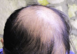 hair implant Exoderm