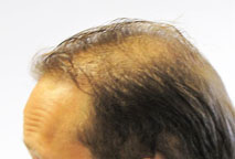 Nido Hair implant Exoderm Medical 